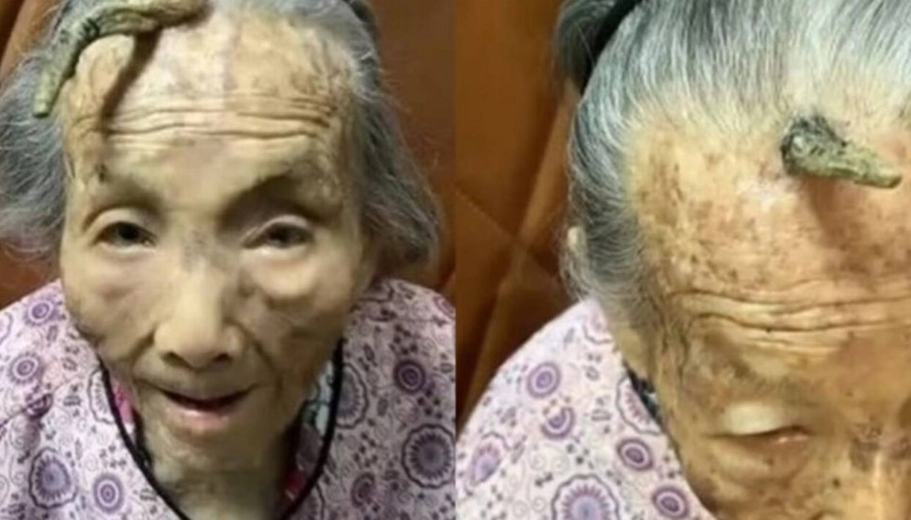 Imagem da postagem Idosa de 107 Anos Surpreende com 'Chifre' de 10cm Crescendo na Testa