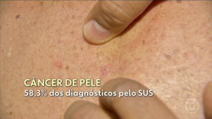 Imagem para Melanomas: entenda por que eles nem sempre são fáceis de identificar